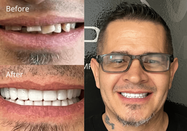 SnapOn Implant Dentures Scottsdale ProSmile Dental Implant Center