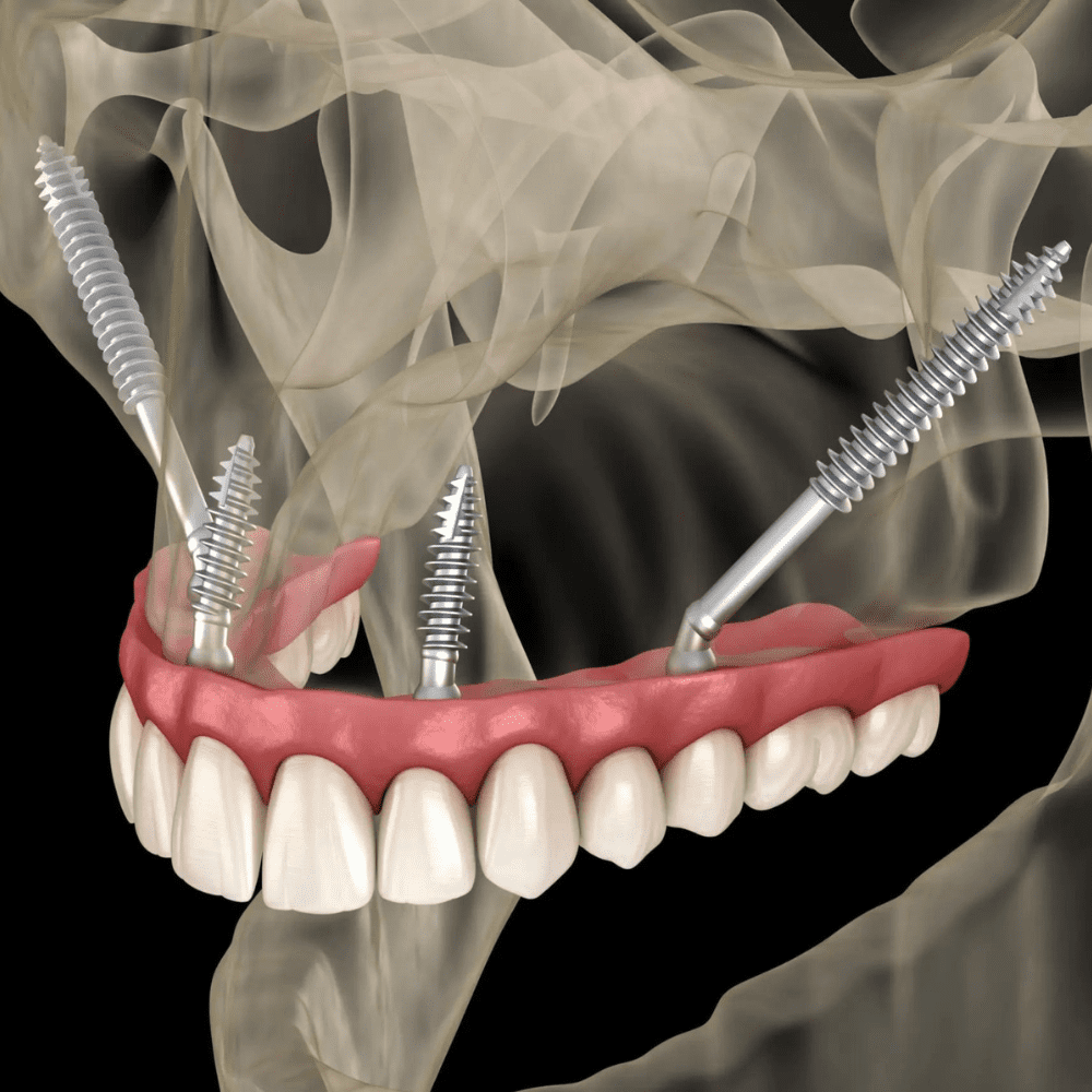 Zygomatic Implants Scottsdale, AZ